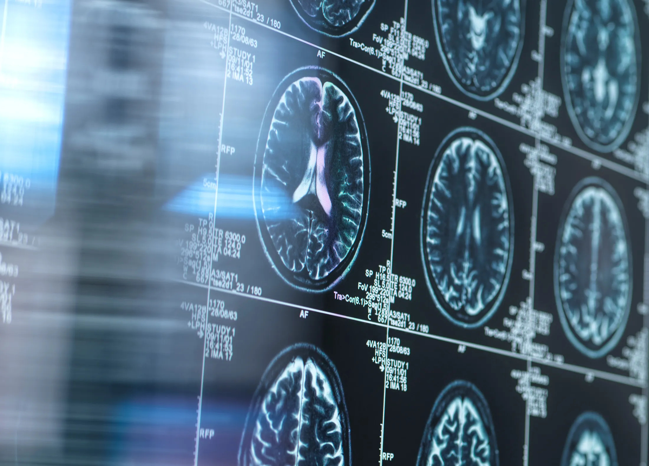 Şwe&yacute;sari&yacute;ada Alsge&yacute;mer keseline garşy dermanyň kliniki synaglary başla&yacute;ar