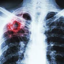 Öýkenleriň ojaklaýyn inçekeseli