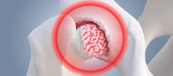 Deformirleýji osteoartroz. podagra