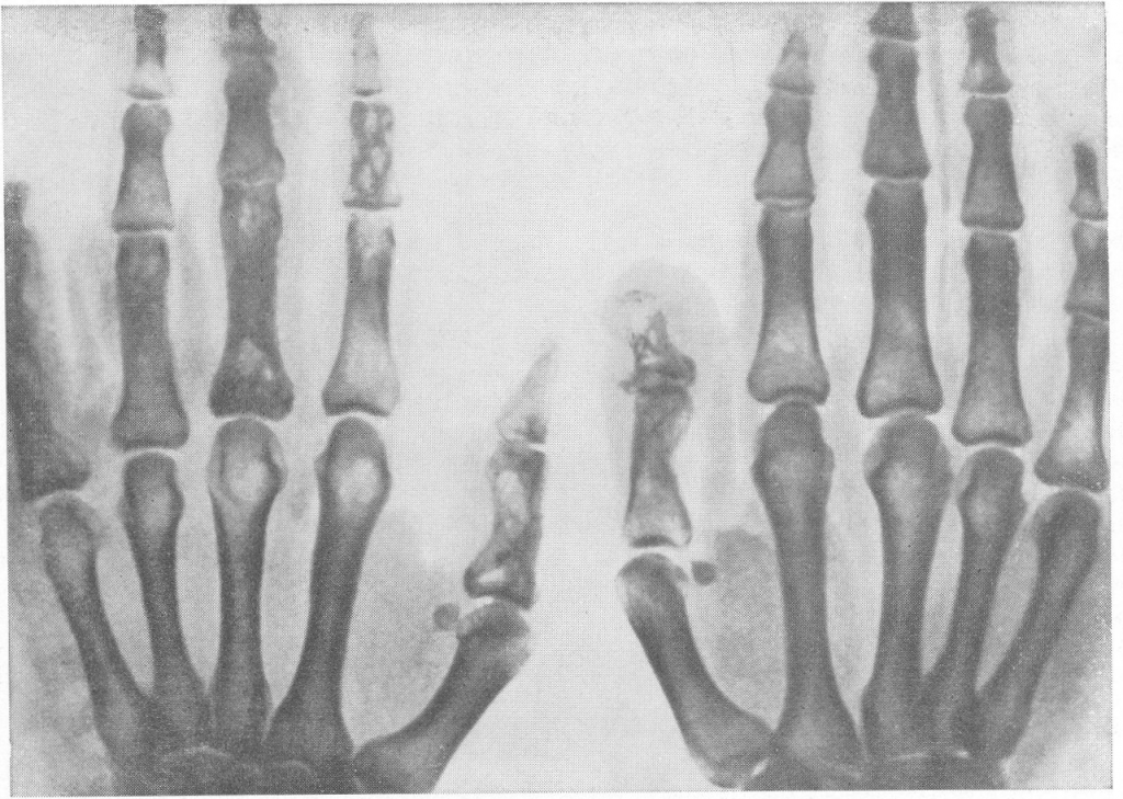 Süňk we bogun inçekeseli.