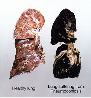 Pnewmokoniozlar