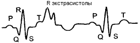 Дифференциальный диагноз нарушений ритма