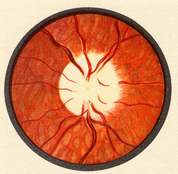 Görüş nerwiň alawlama keselleri - newritler