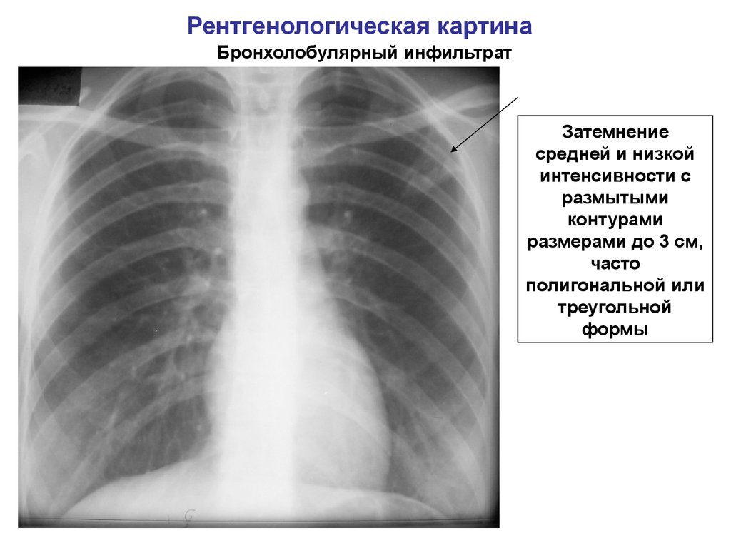 Infiltratiw inçekesel