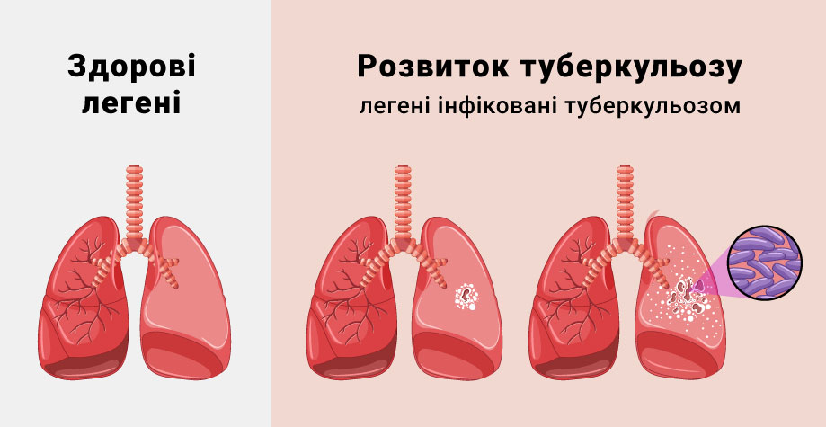 Inçekesel zäherlenmesi