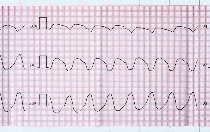 Ýürek geçirijiliginiň we ritminiň ýönekeý bozulmalary....